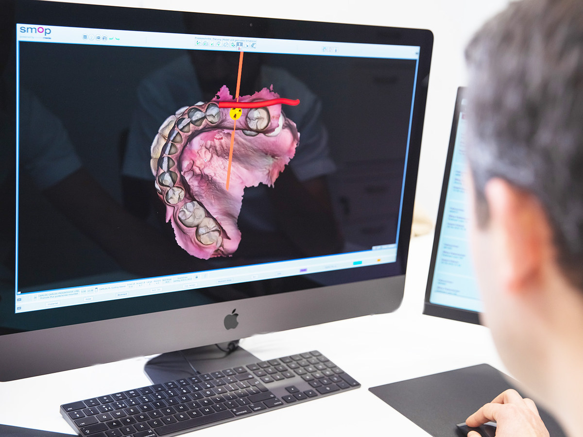 A digital denture design on screen