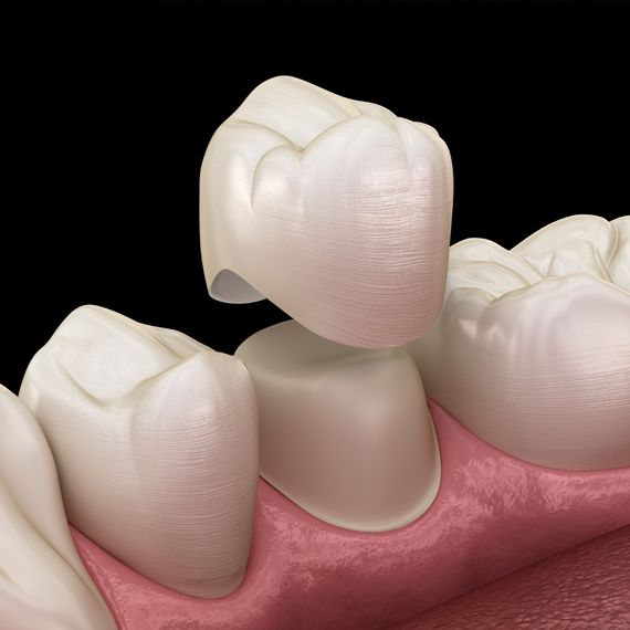 How dental crowns work - german dentist at Wimpolestreet