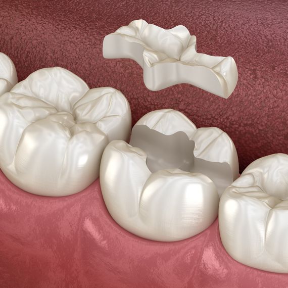 How inlays and partial crowns work - Dental Clinic London