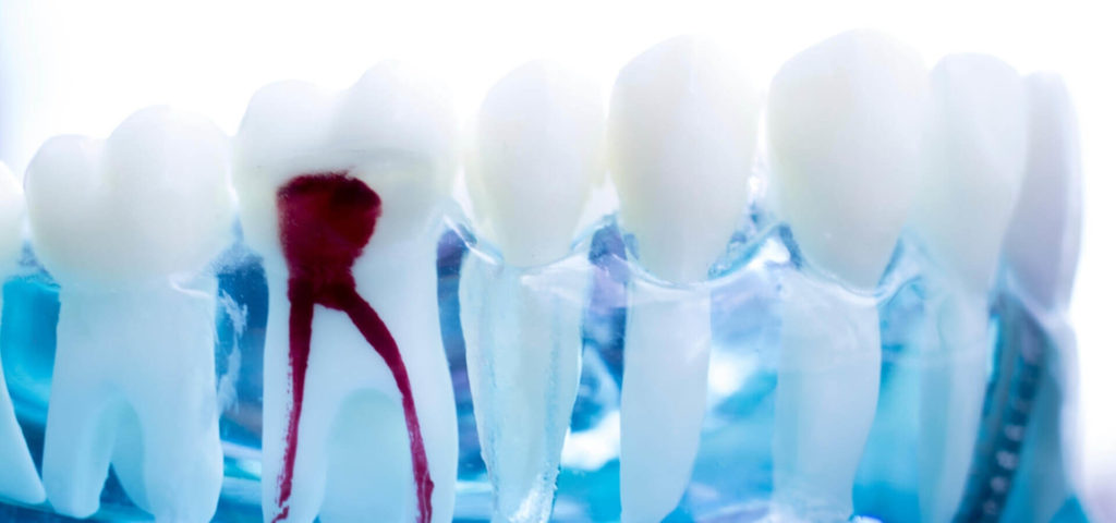 Root Canal Treatment at private Dentists London