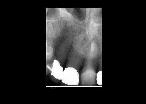 Tooth root