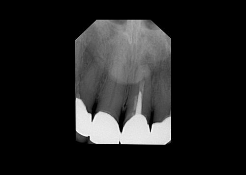 Tooth root