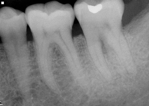 Tooth root