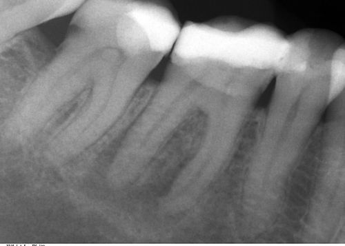 Tooth root