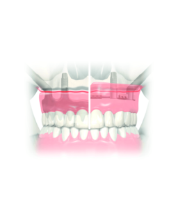 Zygoma Implants at private dentist London