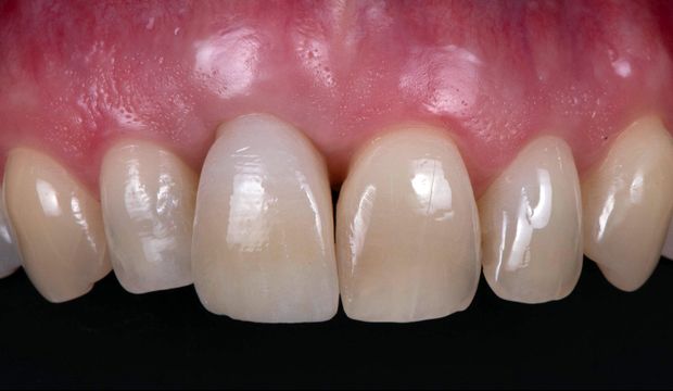 Orthodontics and single-tooth implant after treatment at Dental Clinic Wimpolestreet