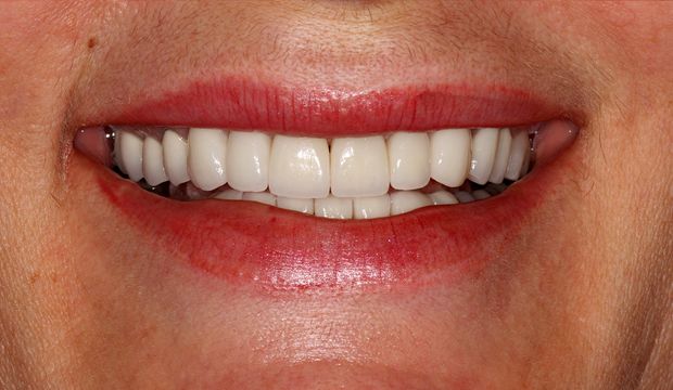 Aesthetic treatment with veneers after
