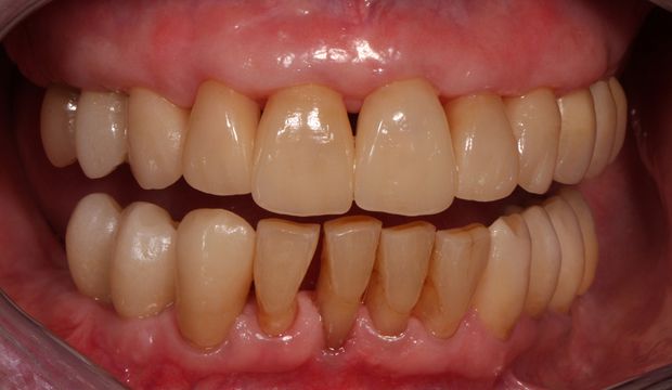 Full mouth reconstruction result at german dentist London