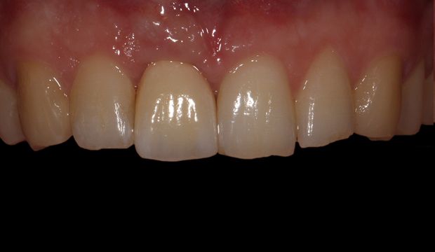 Single implants replacing front teeth at Dental Clinic Wimpolestreet
