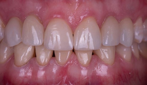 Implants and veneers restoring a smile result