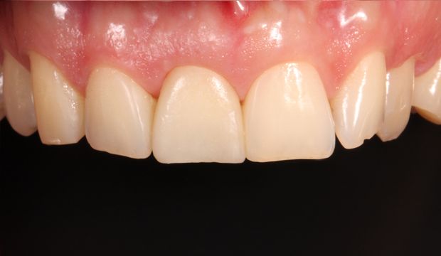Single implant replacing front tooth result at Dental Clinic