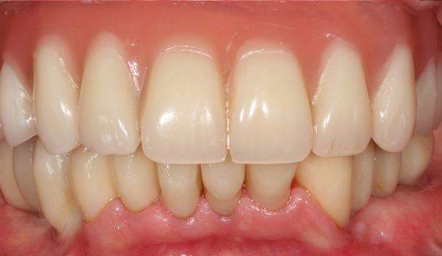 All-on-4, crowns, bridges and single implants after treatment at Dental Clinic London