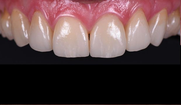Aesthetic treatment with veneers - result of treatment