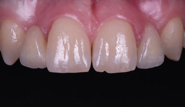 All-ceramic adhesive bridges (Maryland bridges) in the upper jaw result - Dental Clinic London
