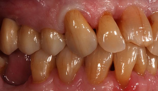 All-ceramic conventional bridge closes the row of teeth - dental office in Wimpolestreet