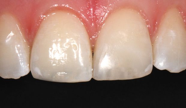 Filling front teeth result after the treatment - Dentist Wimpolestreet