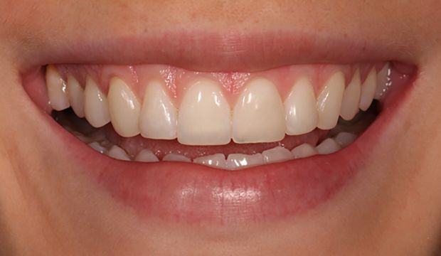 Fillings to improve aesthetics result - Dental Clinic London