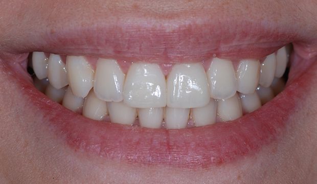 Aesthetic treatment with veneers result - Dental Clinic London