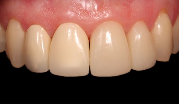 Aesthetic treatment with veneers for teeth - Dental Clinic London