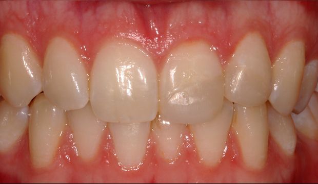 Aesthetic treatment with veneers at Dental Clinic London