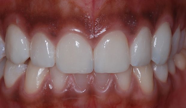 Aesthetic treatment with veneers after - Dental Clinic London