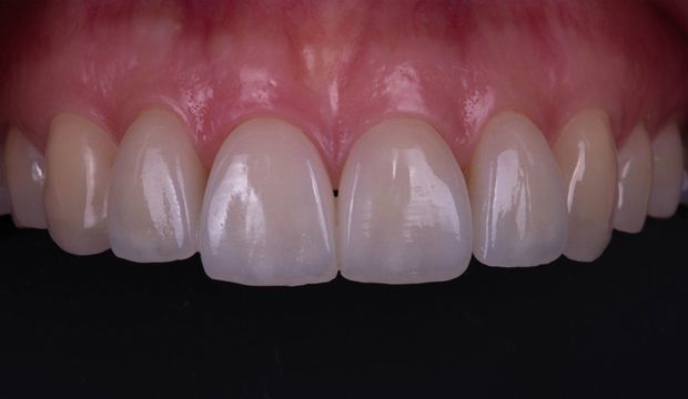 Aesthetic treatment with veneers result of the treatment in London