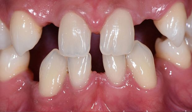 Full mouth reconstruction needed - Dental Clinic London