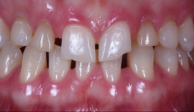 Implants and veneers restoring a smile