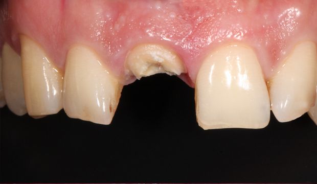 Single implant replacing front tooth - Dental Clinic London