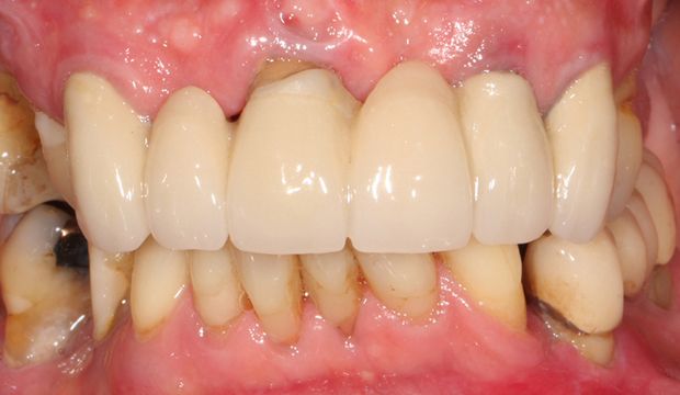 All-on-4, crowns, bridges and single implants before treatment at Dental Clinic