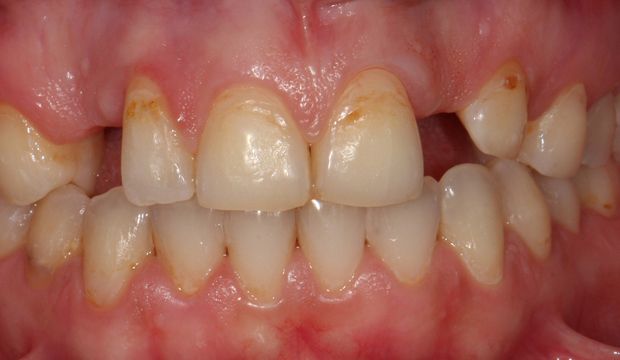 Replacing missing front teeth with Maryland bridges at Dental Clinic London