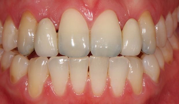 Replacing missing front teeth with Maryland bridges