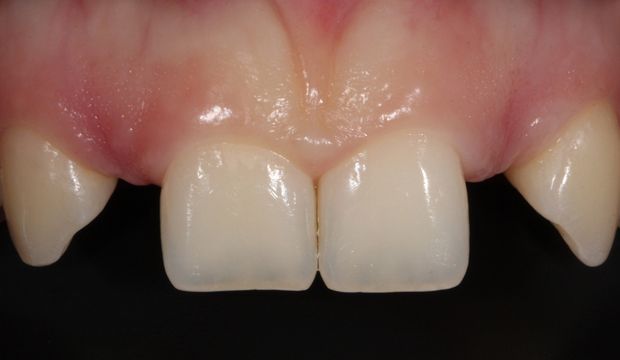 All-ceramic adhesive bridges (Maryland bridges) in the upper jaw before treatment - german dentist Wimpolestreet
