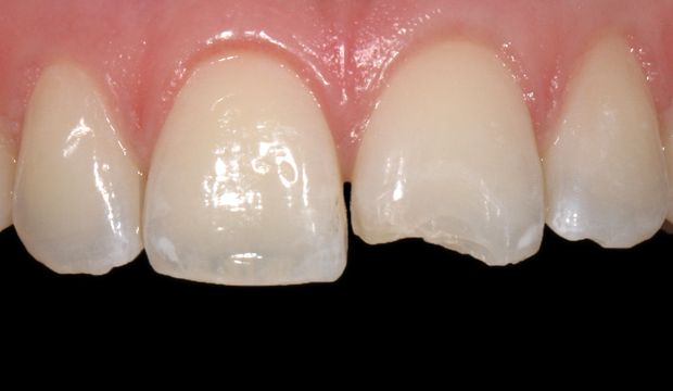 Filling front teeth - Dental Clinic London