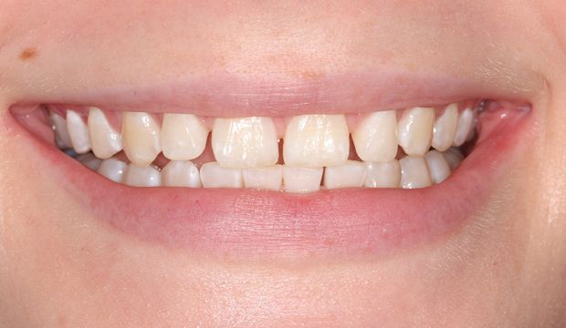 Invisalign/Orthodontics treatment of front teeth with gaps in between them - german dentist London