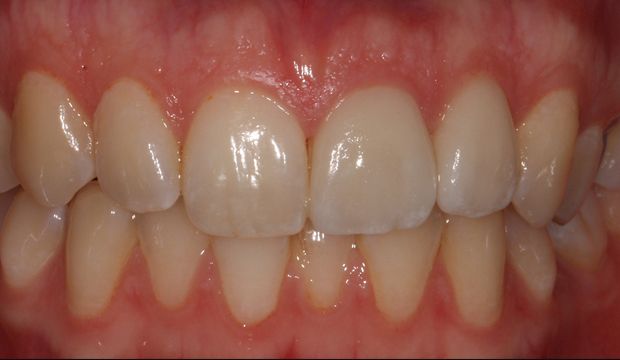 Aesthetic treatment with veneers before treatment - Dental Clinic