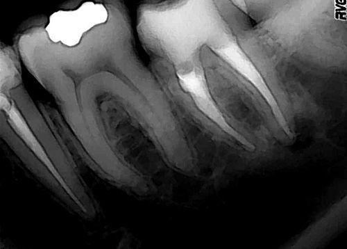 Tooth root