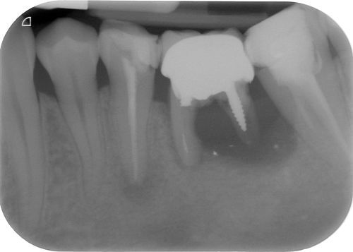 Root canal treatment