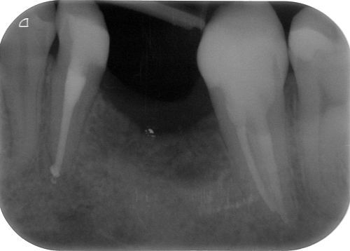 Root canal treatment