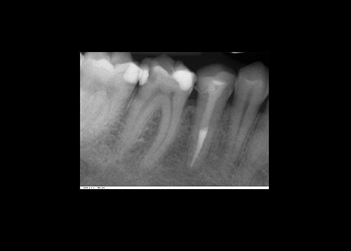Root canal treatment
