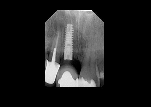 Root canal treatment