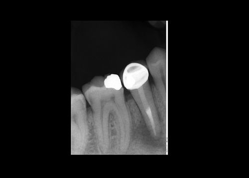 Root canal treatment