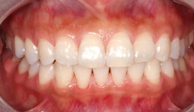 dental hygiene after