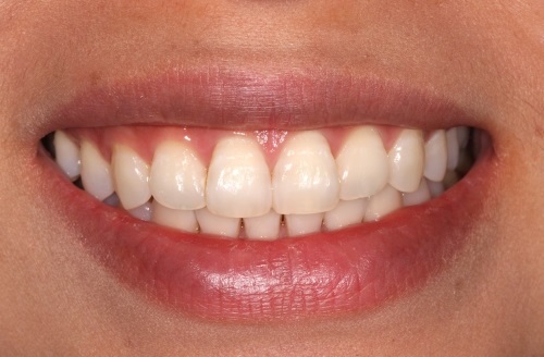 teeth whitening london before