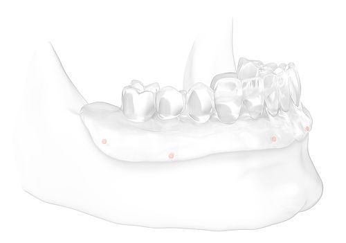 all on 4 dental implants step 3