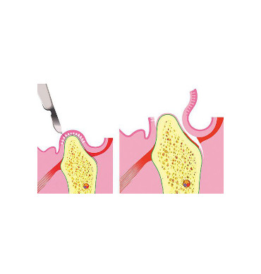 Dental implants illustration