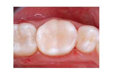 Treatment of root canal at London private dentists