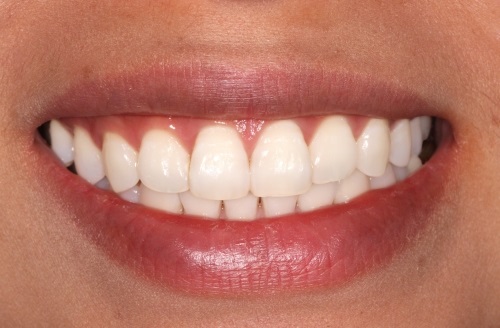 teeth whitening london before after