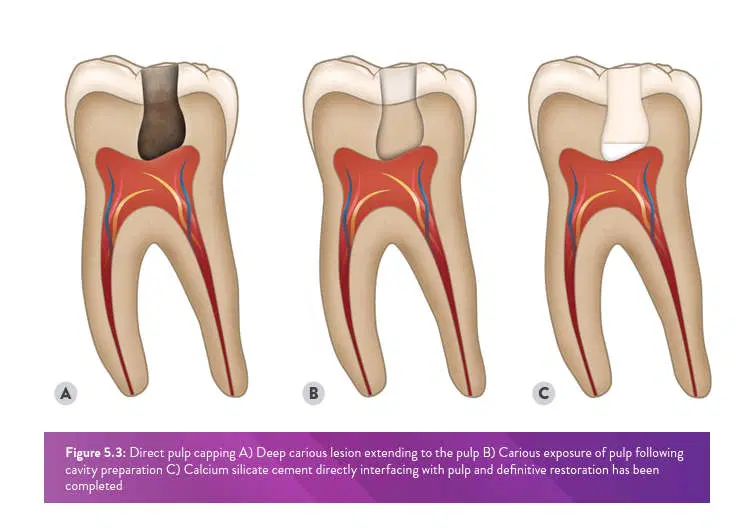 Source: https://britishendodonticsociety.org.uk/_userfiles/pages/files/a4_bes_guidelines_2022_hyperlinked_final.pdf