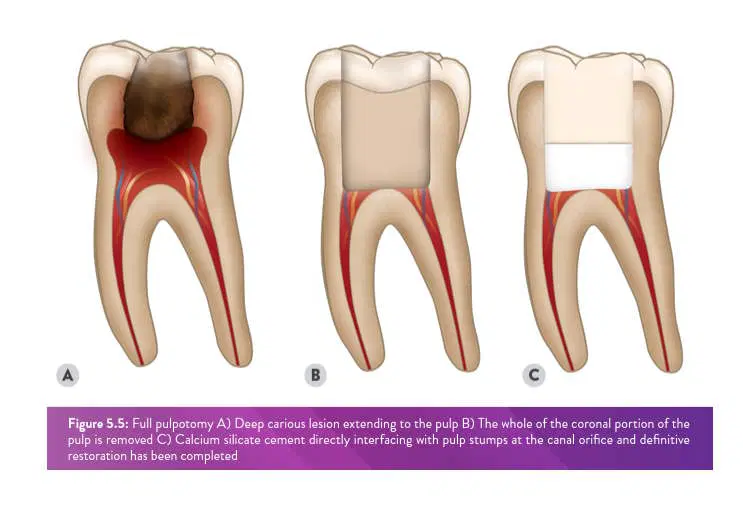 Vital pulp therapy - AbuMaizar Dental Roots Clinic